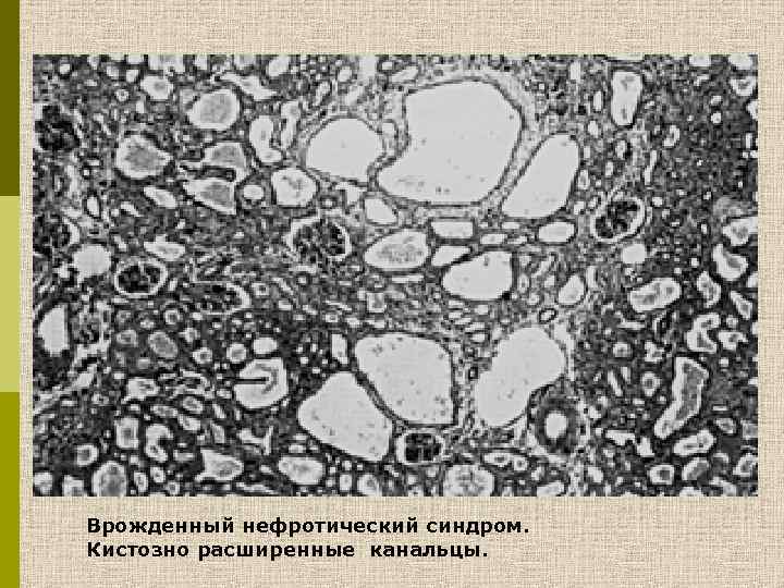 Врожденный нефротический синдром. Кистозно расширенные канальцы. 