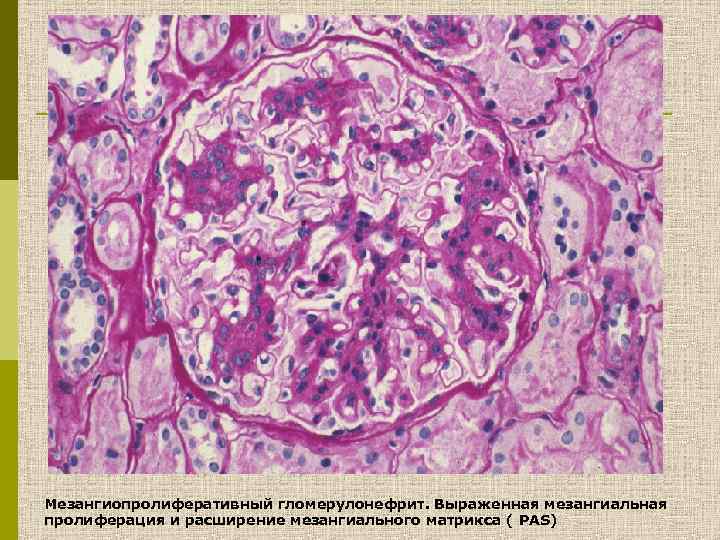 Мезангиопролиферативный гломерулонефрит. Выраженная мезангиальная пролиферация и расширение мезангиального матрикса ( PAS) 