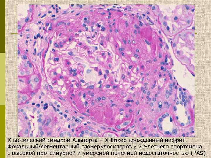 Классический синдром Альпорта – X-linked врожденный нефрит. Фокальный/сегментарный гломерулосклероз у 22 -летнего спортсмена с