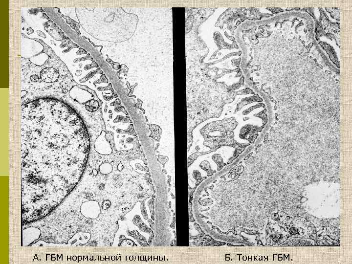 А. ГБМ нормальной толщины. Б. Тонкая ГБМ. 