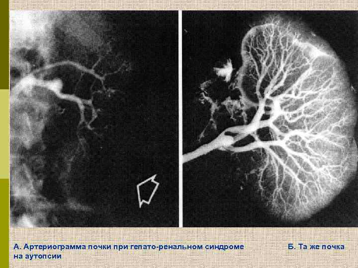 А. Артериограмма почки при гепато-ренальном синдроме на аутопсии Б. Та же почка 