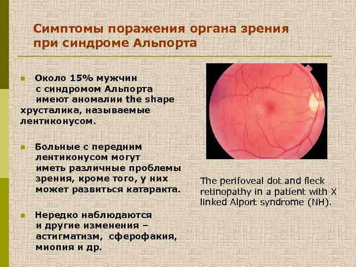 Симптомы поражения органа зрения при синдроме Альпорта Около 15% мужчин с синдромом Альпорта имеют