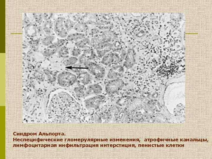 Синдром альпорта презентация