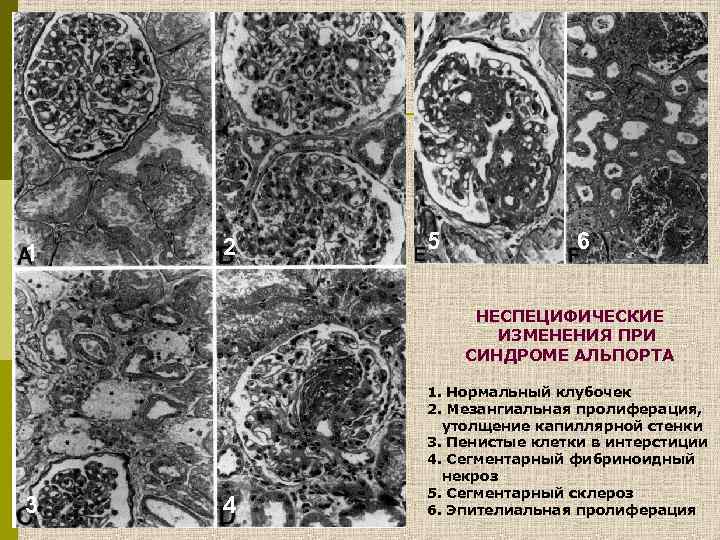 Синдром альпорта презентация