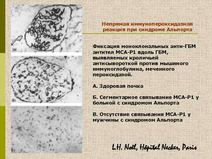 Непрямая иммунопероксидазная реакция при синдроме Альпорта Фиксация моноклональных анти-ГБМ антител МСА-Р 1 вдоль ГБМ,