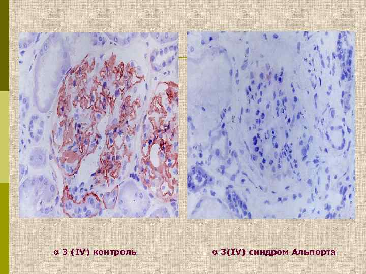  3 (IV) контроль 3(IV) синдром Альпорта 