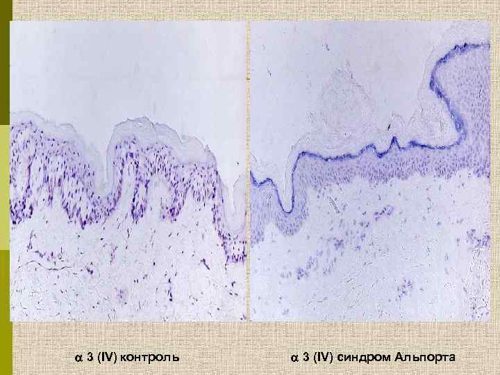  3 (IV) контроль 3 (IV) синдром Альпорта 