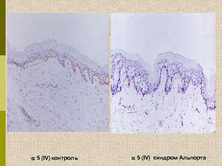  5 (IV) контроль 5 (IV) синдром Альпорта 