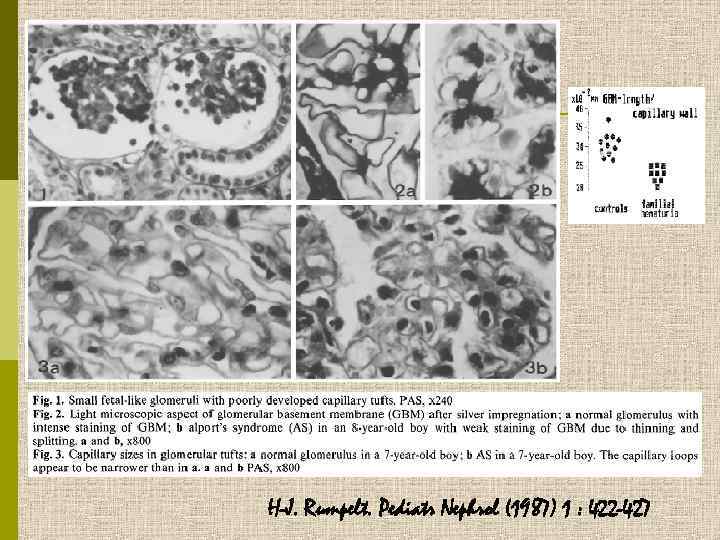 H-J. Rumpelt. Pediatr Nephrol (1987) 1 : 422 -427 