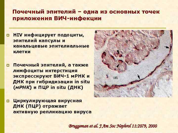 Почечный эпителий – одна из основных точек приложения ВИЧ-инфекции p HIV инфицирует подоциты, эпителий