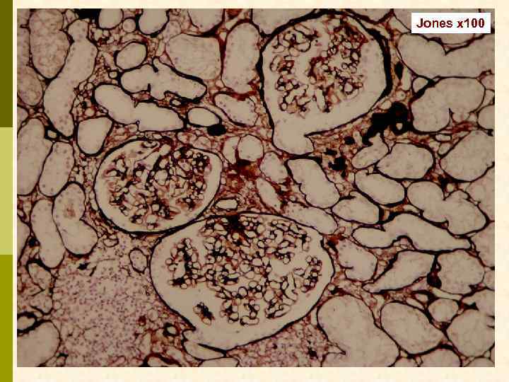 Jones x 100 