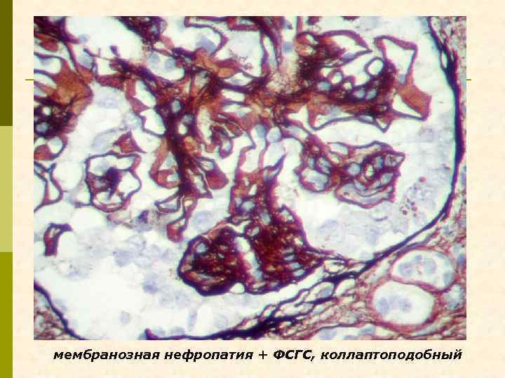 мембранозная нефропатия + ФСГС, коллаптоподобный 