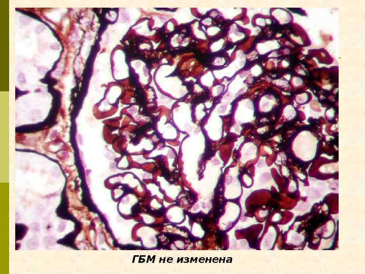 ГБМ не изменена 