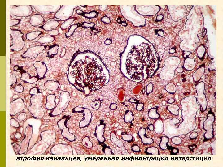 атрофия канальцев, умеренная инфильтрация интерстиция 