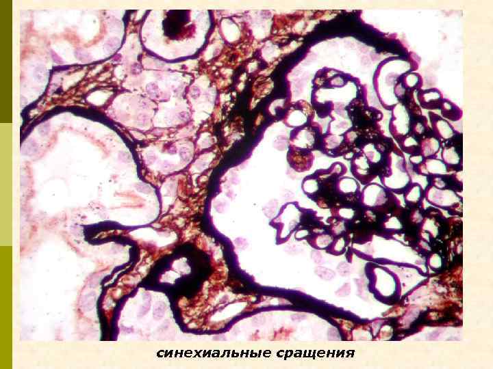 синехиальные сращения 