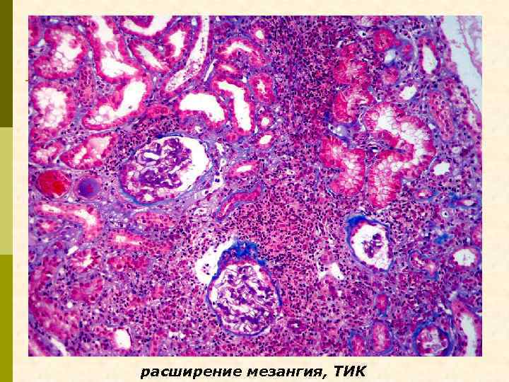 расширение мезангия, ТИК 