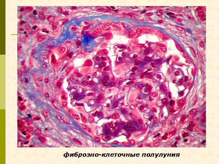 фиброзно-клеточные полулуния 