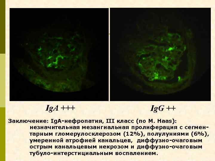 Ig. A +++ Ig. G ++ Заключение: Ig. A-нефропатия, III класс (по M. Haas):