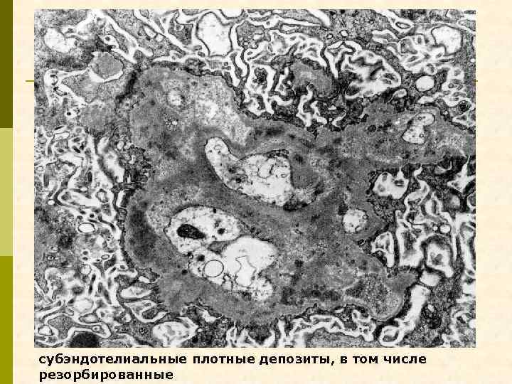 субэндотелиальные плотные депозиты, в том числе резорбированные 