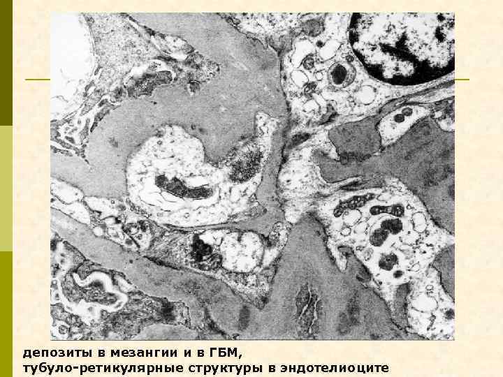 депозиты в мезангии и в ГБМ, тубуло-ретикулярные структуры в эндотелиоците 