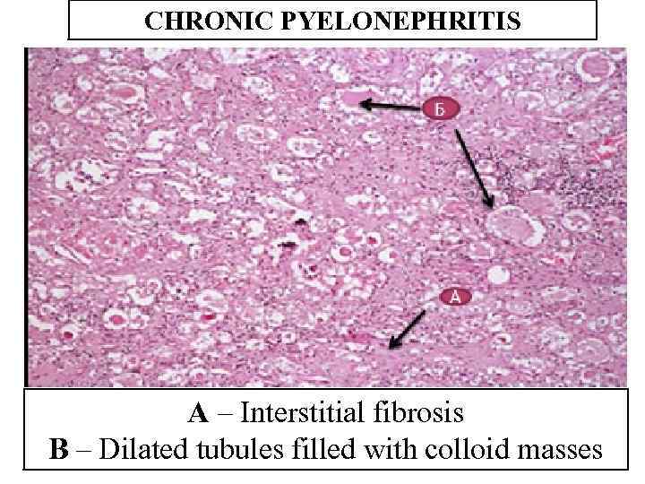 CHRONIC PYELONEPHRITIS A – Interstitial fibrosis B – Dilated tubules filled with colloid masses