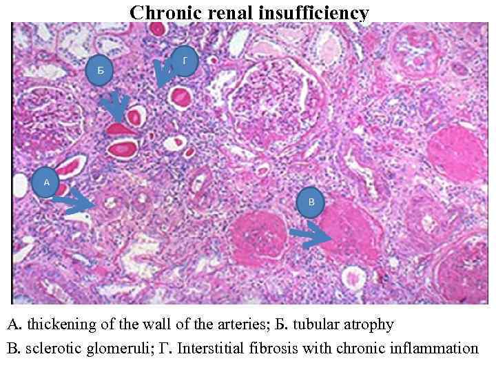 Chronic renal insufficiency A. thickening of the wall of the arteries; Б. tubular atrophy