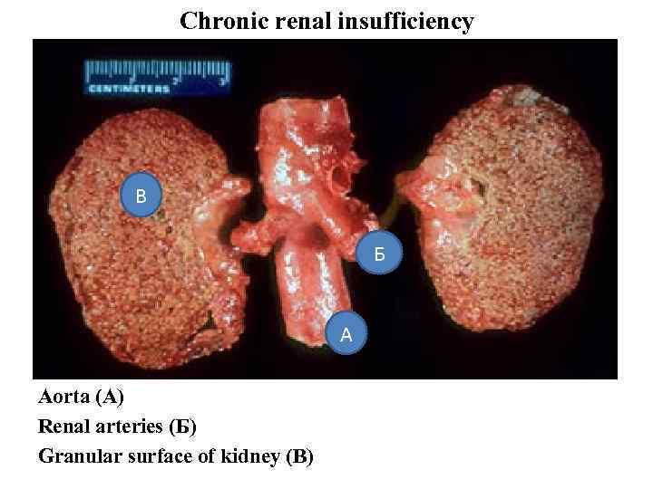 Chronic renal insufficiency В Б А Aorta (A) Renal arteries (Б) Granular surface of