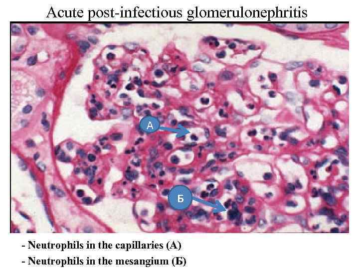 Acute post-infectious glomerulonephritis А Б - Neutrophils in the capillaries (A) - Neutrophils in