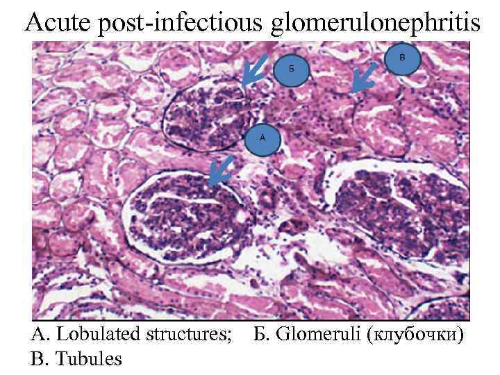 Acute post-infectious glomerulonephritis А. Lobulated structures; В. Tubules Б. Glomeruli (клубочки) 