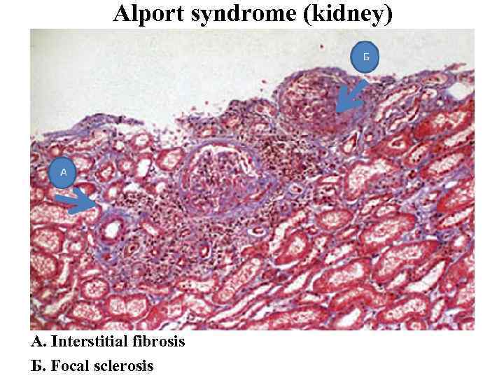 Alport syndrome (kidney) A. Interstitial fibrosis Б. Focal sclerosis 