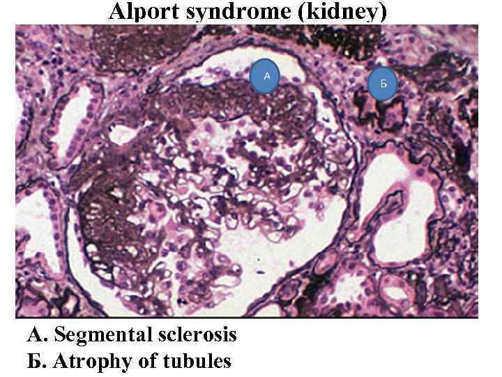 Alport syndrome (kidney) A. Segmental sclerosis Б. Atrophy of tubules 