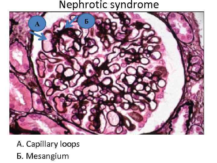 Nephrotic syndrome А A. Capillary loops Б. Mesangium Б 