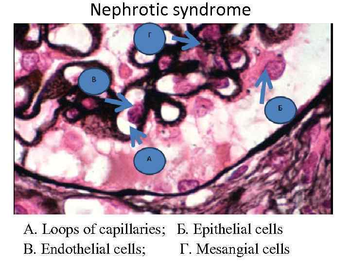 Nephrotic syndrome А. Loops of capillaries; Б. Epithelial cells В. Endothelial cells; Г. Mesangial