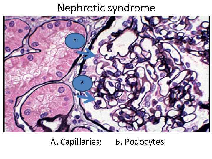 Nephrotic syndrome A. Capillaries; Б. Podocytes 