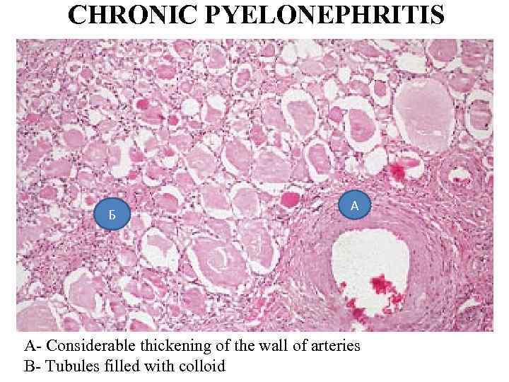 CHRONIC PYELONEPHRITIS Б А A- Considerable thickening of the wall of arteries B- Tubules