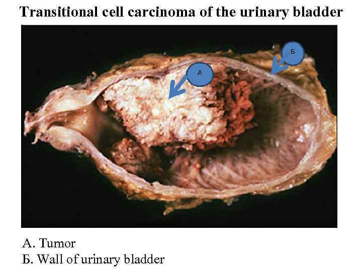 Transitional cell carcinoma of the urinary bladder А. Tumor Б. Wall of urinary bladder