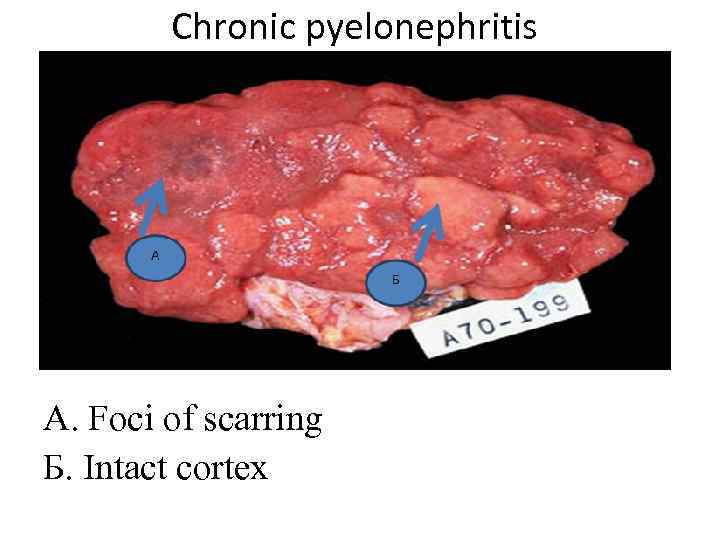 Chronic pyelonephritis А. Foci of scarring Б. Intact cortex 