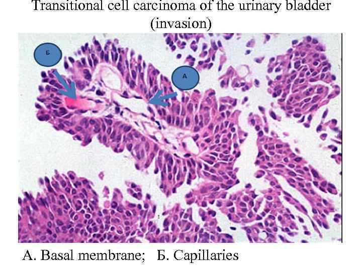 Transitional cell carcinoma of the urinary bladder (invasion) А. Basal membrane; Б. Capillaries 