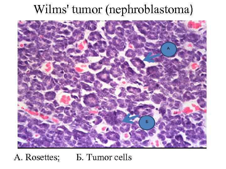 Wilms' tumor (nephroblastoma) A. Rosettes; Б. Tumor cells 