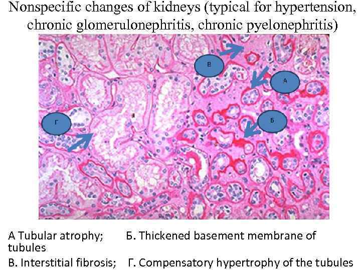 Nonspecific changes of kidneys (typical for hypertension, chronic glomerulonephritis, chronic pyelonephritis) A Tubular atrophy;