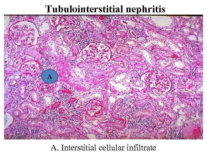 Tubulointerstitial nephritis A А. Interstitial cellular infiltrate 