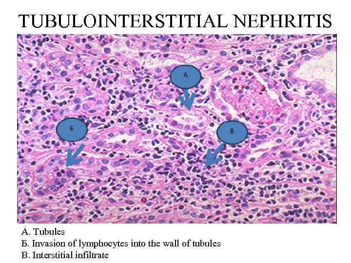 TUBULOINTERSTITIAL NEPHRITIS А. Tubules Б. Invasion of lymphocytes into the wall of tubules В.