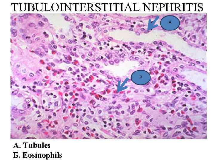 TUBULOINTERSTITIAL NEPHRITIS А. Tubules Б. Eosinophils 