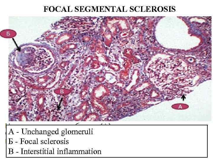 FOCAL SEGMENTAL SCLEROSIS A - Unchanged glomeruli Б - Focal sclerosis В - Interstitial