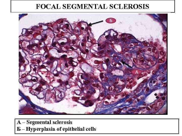 FOCAL SEGMENTAL SCLEROSIS A – Segmental sclerosis Б – Hyperplasia of epithelial cells 