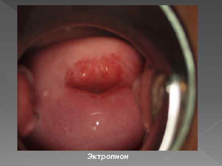 Эктропион 