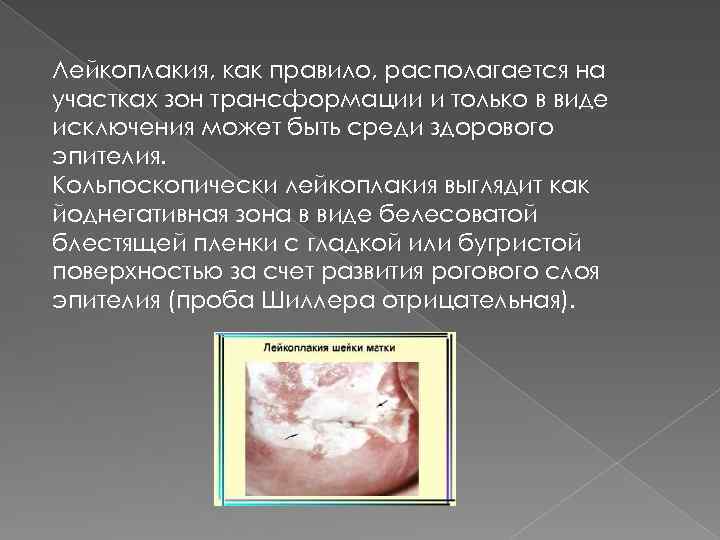 Лейкоплакия, как правило, располагается на участках зон трансформации и только в виде исключения может