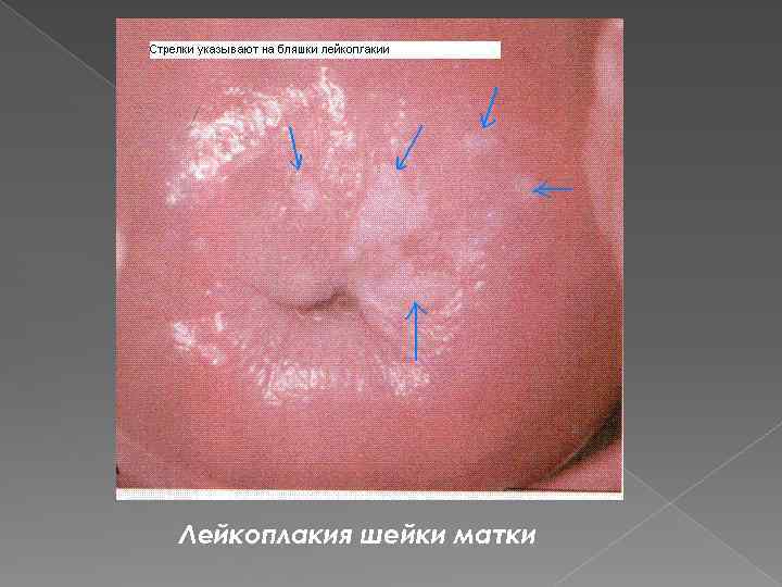 Лейкоплакия шейки матки 