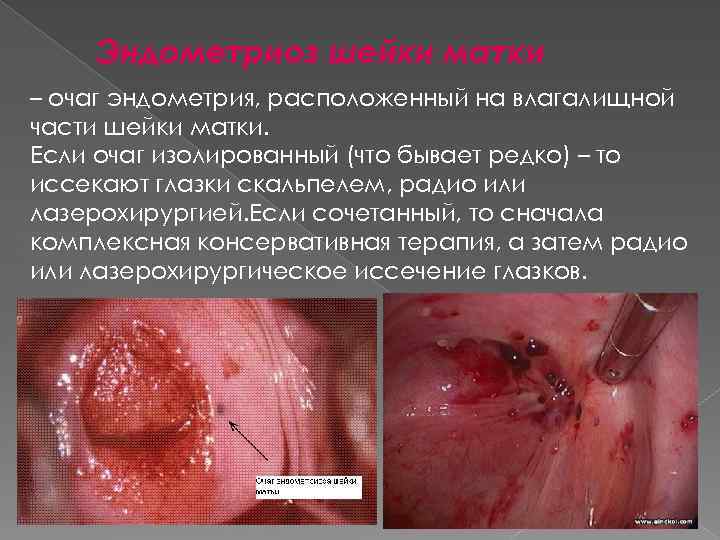 Эндометриоз шейки матки – очаг эндометрия, расположенный на влагалищной части шейки матки. Если очаг