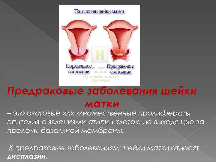 Предраковые заболевания шейки матки – это очаговые или множественные пролифераты эпителия с явлениями атипии